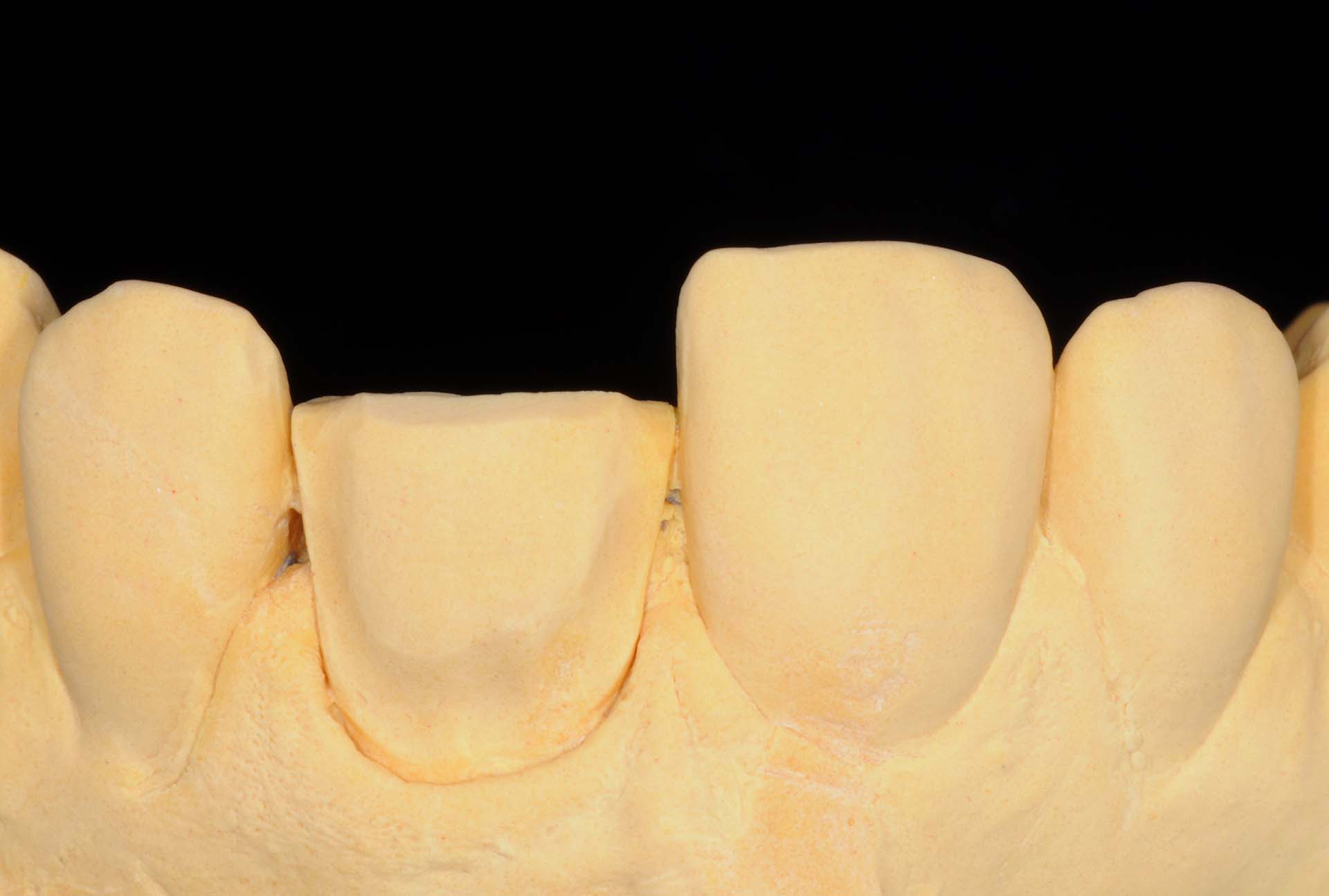Veneer 21